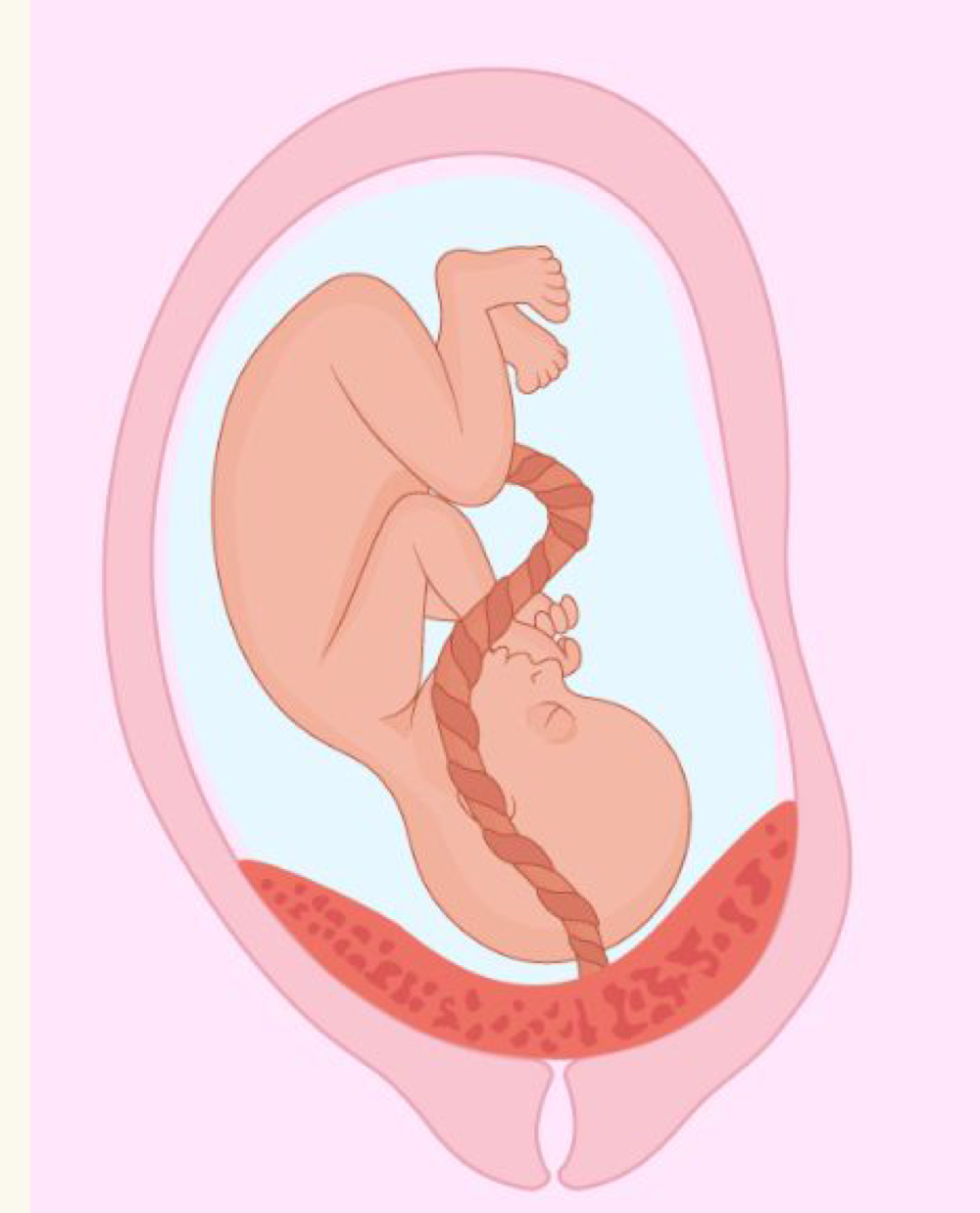<p>placenta previa </p>