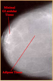 <p>fatty breast consists of mainly adipose tissue with minimal glandular tissue</p><p>(remember density can only be determined on a mammogram as the look and feel of a breast does not indicate the ratio of fatty to fibroglandular tissue</p>