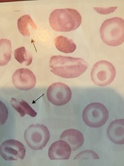 <p>Glove-like intracellular crystals, hemoglobin SC disease</p>