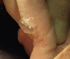 <p>What is this, present in the lung of a dog that presented with spontaneous pneumothorax?</p>