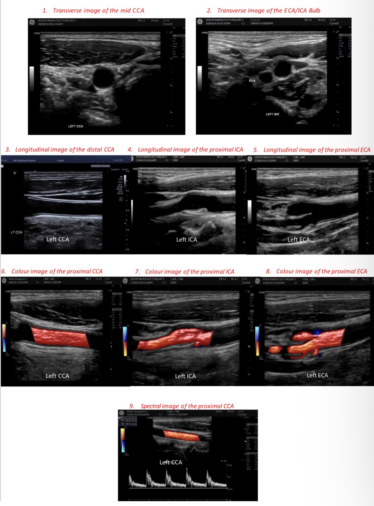 <p>1) Image of transverse CCA</p><p>2) Image of transverse ECA / ICA bulb </p><p>3) Image of longitudinal distal CCA </p><p>4) Image of proximal CCA with colour </p><p>5) Image of Spectral Doppler and measurement of peak of proximal CCA</p><p>6) Image of longitudinal proximal ICA </p><p>7) Image of longitudinal proximal ICA with colour </p><p>8) Image of longitudinal proximal ECA </p><p>9) Image of longitudinal proximal ECA with Colour </p>