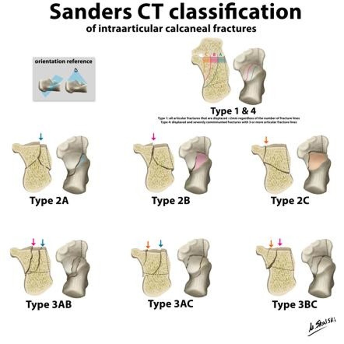 <p>SANDERS - Calcaneal fx</p><p>Used for CT evaluation from coronal and axial views</p><p>Classified by number of pieces</p><p>Lines A and B divide the inferior portion of the posterior talar facet into 3 equal portions.</p><p>Line C separates the medial and posterior facets.</p><p>A - lateral</p><p>B - midline</p><p>C - medial (at sustentaculum tali)</p><p>1 - any number of fracture lines</p><p>- All non-displaced, extra-articular fractures</p><p>2 - one fracture line</p><p>Two-part fracture of posterior facet</p><p>Use one letter (2A, 2B, or 2C)</p><p>3 - two fracture lines</p><p>Three-part, intra-articular fracture of posterior facet with depressed central fragment</p><p>Use two letters (3AB, 3AC, or 3BC)</p><p>4 - three fracture lines</p><p>Four-part, intra-articular fracture of posterior facet and sustentaculum fragment with high degree of comminution</p>