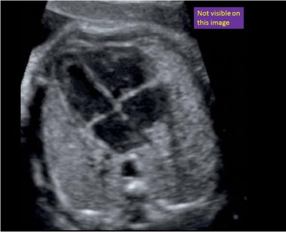 <p>Locate the inferior vena cava. The structure may or may not be visible on this image</p>