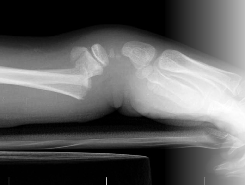 <p>What is the MOI for a Colle’s fracture? </p>