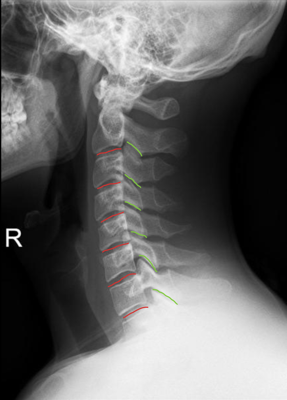 <p><span>椎间盘</span></p>