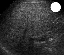 <p>how would you grade this liver for fatty infiltration</p>