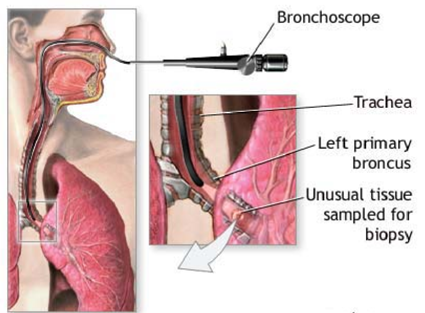 <p>Bronchoscope accesses left/right primary bronchus</p><p>Samples unusual tissue</p>