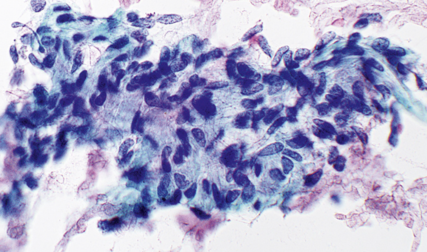 <p>Cytologie parotide </p><p>1) Catégorie selon Milan</p><p>2) Diagnostic</p>
