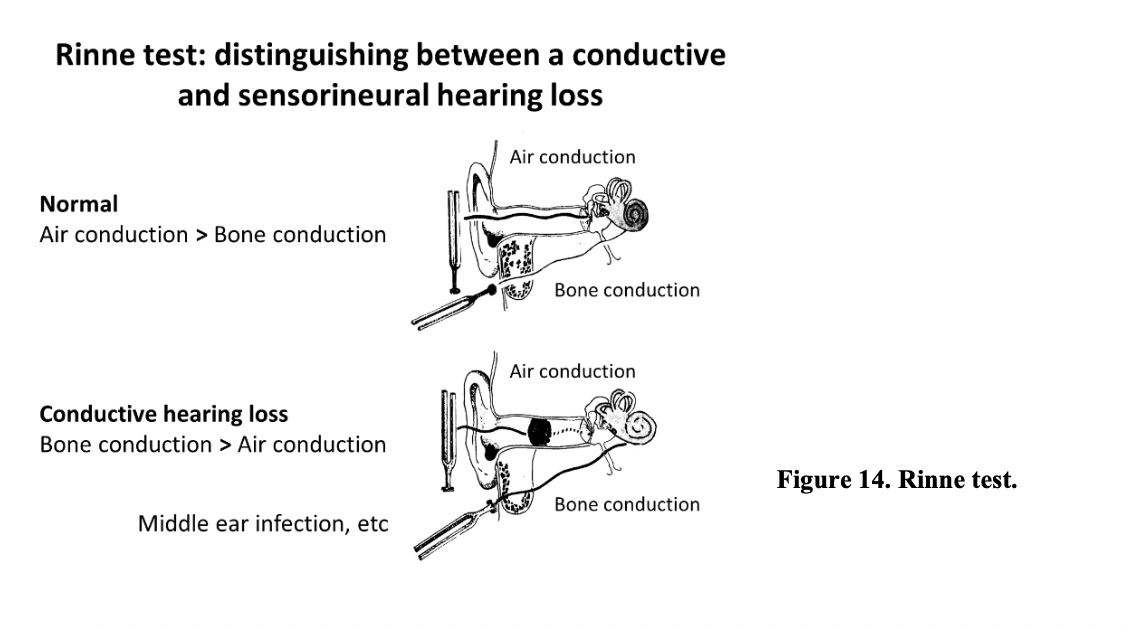 <p><strong>Rinne test</strong></p><ol><li><p>place a vibrating tuning fork on the mastoid process </p><ul><li><p>Patient indicates when they can no longer hear sound</p><ul><li><p><strong>Indicates Bone conduction of sound</strong></p><ul><li><p>(transmission of sound to the cochlea via the skull)</p></li></ul></li></ul></li></ul></li><li><p>Fork at the entrance of the external auditory meatus (EAM)</p><ul><li><p><strong>Tests for air conduction</strong></p></li></ul></li></ol><p>RESULT:</p><ul><li><p><strong>Conductive:</strong> </p><ol><li><p>bone conduction is unimpaired</p></li><li><p>response to sound conducted by the EAM is <strong>reduced</strong></p><ul><li><p>Bone > Air</p></li></ul></li></ol></li><li><p><strong>Sensorineural (or normal)</strong>:</p><ol><li><p>Bone conduction impaired</p></li><li><p>Greater sensitivity to air conduction at the EAM</p><ul><li><p>Air > Bone</p></li></ul></li></ol></li></ul><p></p>