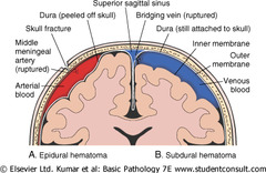 <p>blunt head trauma from an MVA</p>
