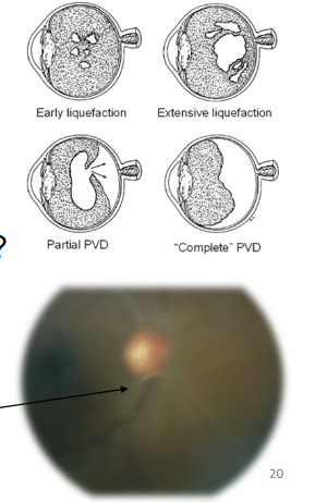 <ul><li><p>Who is affected? </p><ul><li><p>Typically people in their 50-60s </p></li><li><p>Can occur earlier in life especially in high myopes </p></li></ul></li><li><p>Symptoms? </p><ul><li><p>Blurry vision, flashes and floaters </p></li></ul></li><li><p>Development and clinical signs? </p><ul><li><p>Syneresis of vitreous </p></li><li><p>Pockets of syneretic fluid </p></li><li><p>Posterior hylaloid “breakthrough” </p></li><li><p>Weiss Ring </p></li><li><p>Haem/ Tobacco dust consider HST </p></li></ul></li><li><p>Note the Weiss Ring which is in focus, compared to the blurry (not focussed) ONH: this indicates that both are not at the same depth....i.e. the vitreous has detached from the retina</p></li></ul><p></p>