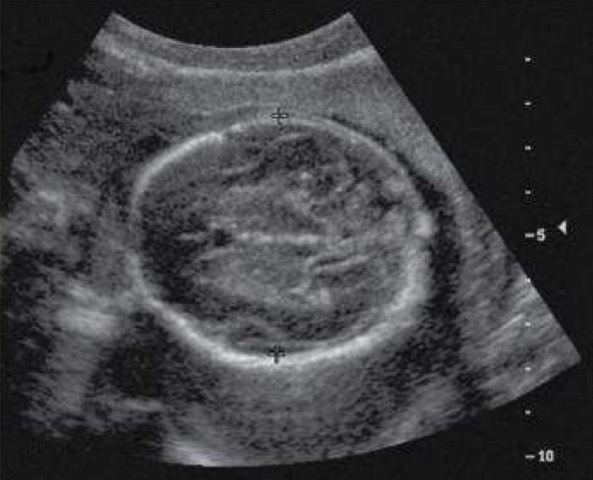 <p>In almost all normal cases, the mandible, bony nasal ridge, and orbits can be visualized</p>