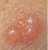 <p><span>Elevated, circumscribed, fluid-filled <1 cm (e.g., chickenpox, shingles).</span></p>