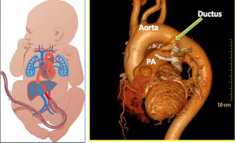 <p>patent ductus arteriosus does what after birth </p>