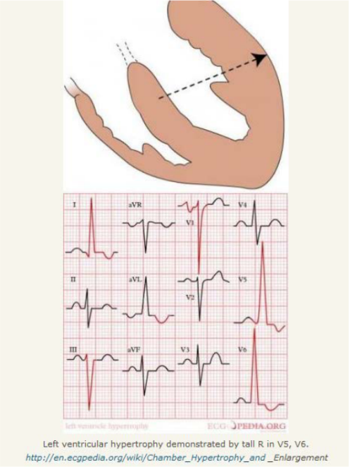 <p>ECG may show <strong>LVH</strong>.</p>