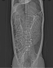 <p>Spontaneous massive colonic dilation without mechanical obstruction, occurring in postoperative or critically ill patients.</p><p>Dilation predominantly affects the cecum and ascending colon, and if left untreated, excessive distension can compromise the blood supply to the colon, leading to ischemia or perforation.</p><p>Risk factors: hospitalization, post-surgical (3-5 days), trauma, metabolic imbalance, malignancy, MI, CHF, pancreatitis, or recent neurologic event</p><p>-Opioid pain medications may be a contributing factor</p><p>-usually elderly age group</p>