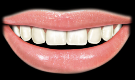 <ul><li><p>reveal interproximal gingival only → papilla </p></li><li><p>reveal 75-100% of anterior teeth </p></li></ul><p></p>