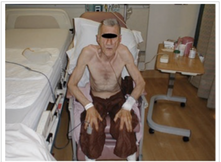 <p><span>The nurse observes the client sitting at the side of the bed in the position shown. What health problem should the nurse suspect the client is experiencing?</span></p>