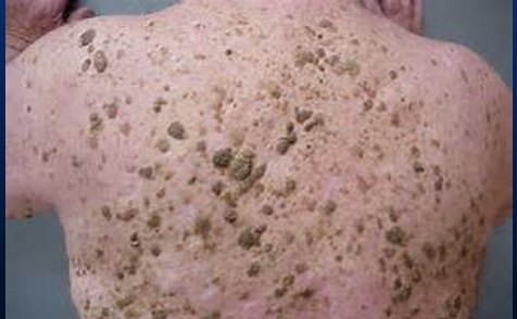 <p>Benign brown, waxy or clay-like epidermal lesions. doesn't turn into cancer</p>