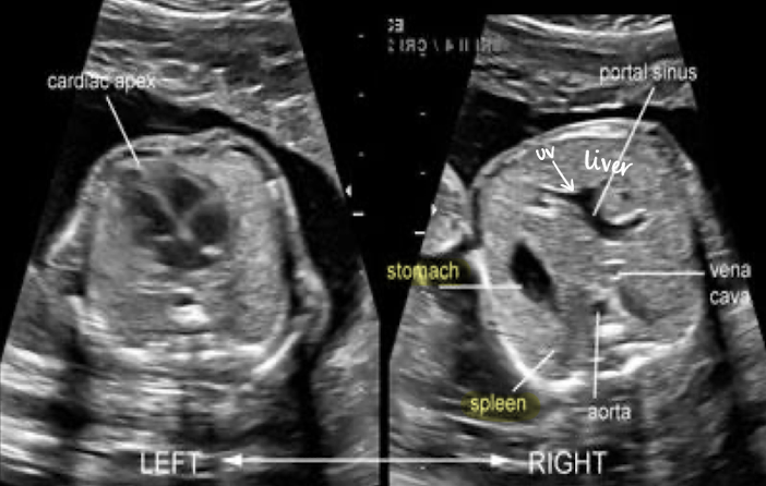 <ul><li><p>in LUQ</p></li><li><p>seen by 16w</p></li><li><p>amniotic, fluid-filled structure</p></li><li><p>if no fluid seen, evaluate 20-30 minutes</p></li><li><p>used as a marker for taking AC measurement</p></li></ul><p></p>
