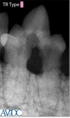 <p>what type of tooth resorption is this?</p>