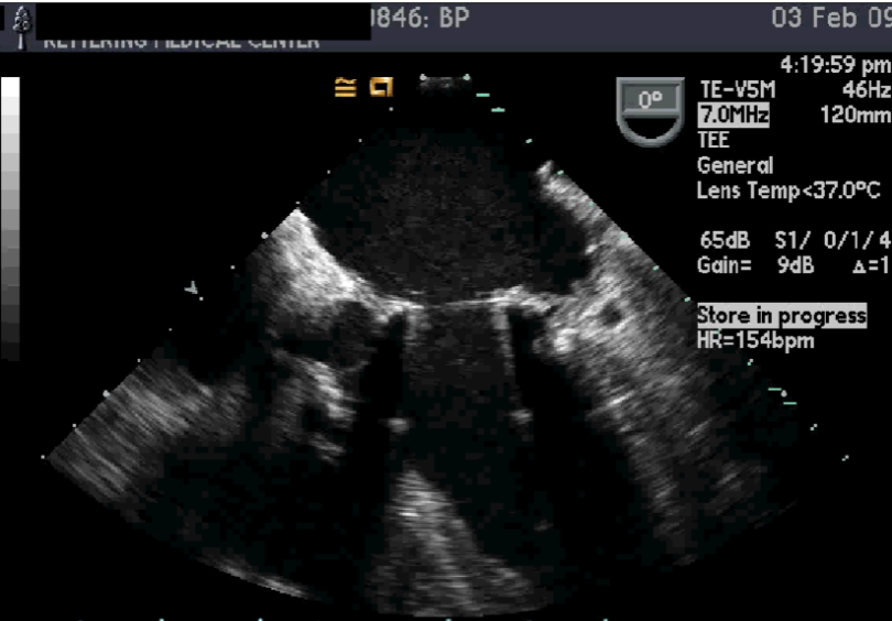 <ul><li><p>rupture of one or more of the sutures that anchor the sewing ring of prosthesis to annulus</p><ul><li><p>“rocking of the valve” appearance</p></li></ul></li><li><p>usually occurs soon after surgery</p></li><li><p>may be d/t infection eroding valve</p></li><li><p>may be associated w/ abscess formation</p></li></ul><p></p>