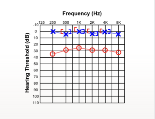 <p> what type of hearing loss</p>