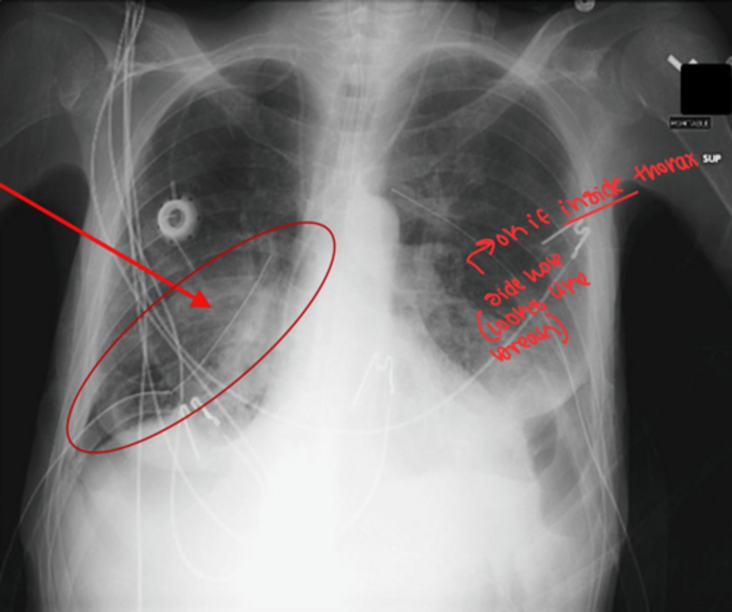 <p>start looking on outside of body and trace it in and up</p>