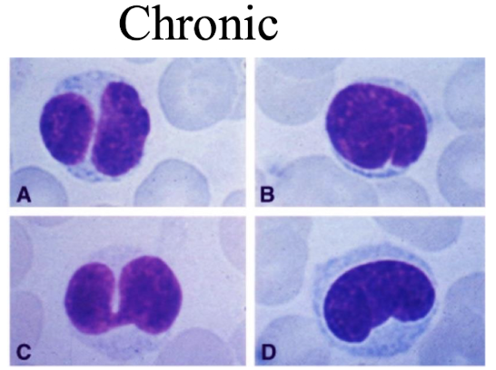 <p><strong>T cells show <mark data-color="purple" style="background-color: purple; color: inherit;">moderate pleomorphism</mark></strong> (<span>marked variability in the size, shape, and staining of cells<strong>) and/or their nuclei </strong></span></p><ul><li><p><strong>Irregular nuclei and a higher nucleus-to-cytoplasm ratio compared to normal T cells.</strong> </p></li><li><p>They may present with more pronounced atypia and are <span style="color: red;"><strong>associated with a higher percentage of abnormal cells. </strong></span></p></li></ul><p></p>