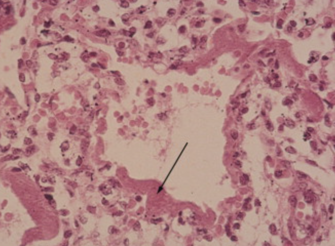 <p>Neonatal pulmonary distress syndrome (hyaline membrane disorder) </p>