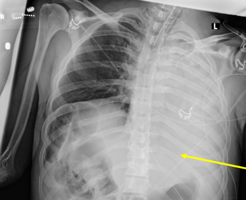 <p>Complete or partial collapse of the entire lung caused by bronchial obstruction.</p>