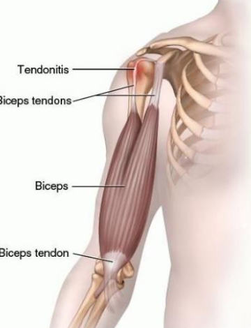 <p>Bicipital Tendinitis</p>