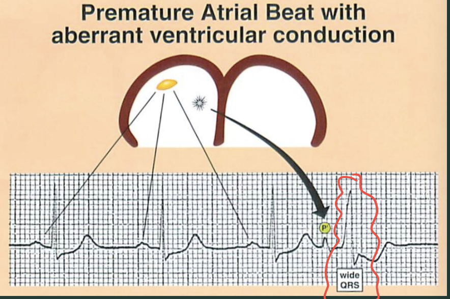 <p>What’s PAB/PAC with aberrant vent conduction?</p>