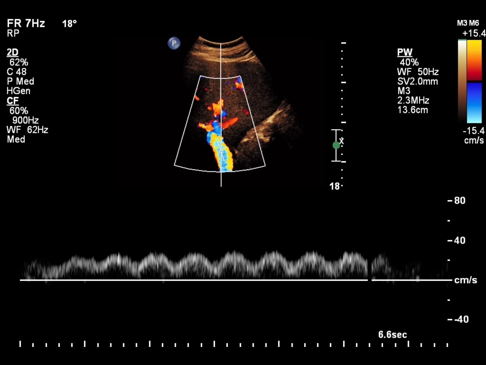 <p>Pattern in portal vein. What do you suspect?</p>