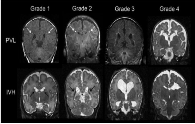 <p><span>necrosis and softening of white matter near the brain's ventricles, which can contribute to neurodevelopmental delays and other brain complications </span></p><ul><li><p>most common in premies</p></li></ul><p></p>