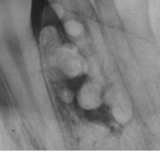 <p>13 y/o, asymptomatic, multiple small radiopacitis in anteerior mandible, diagnosis?</p>