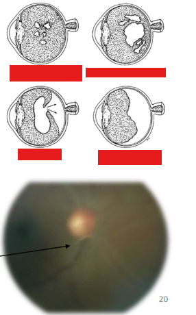 <p>Posterior Vitreous Detachment</p><ul><li><p>Who is affected</p></li><li><p>Symptoms</p></li><li><p>Development and clinical signs</p></li></ul><p></p>