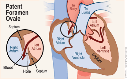 <p>hole in the heart; stays open after birth</p>
