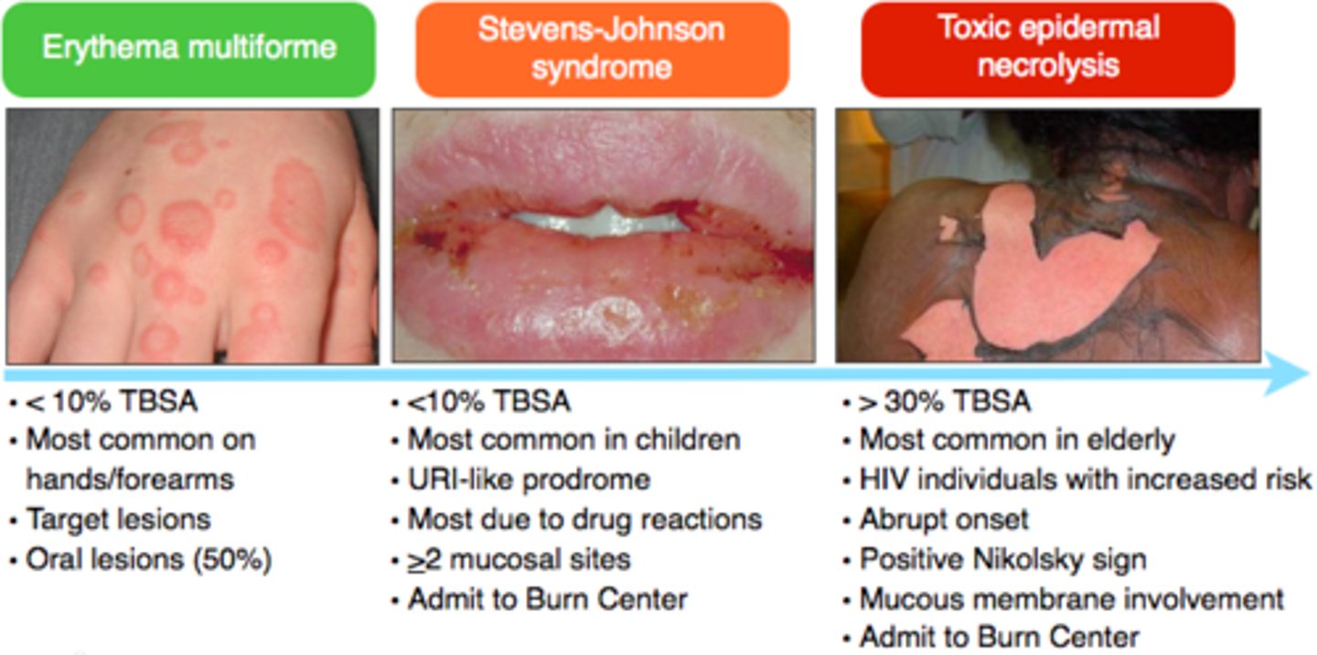 <p>EM may appear similar to Steven Johnson Syndrome (SJS) but SJS has a more generalized distribution of lesions; concentrated on the trunk (EM extremities and mouth), an absence of raised typical target lesions and atypical flat (not raised) target lesions or macules with the coalescence of lesions</p>