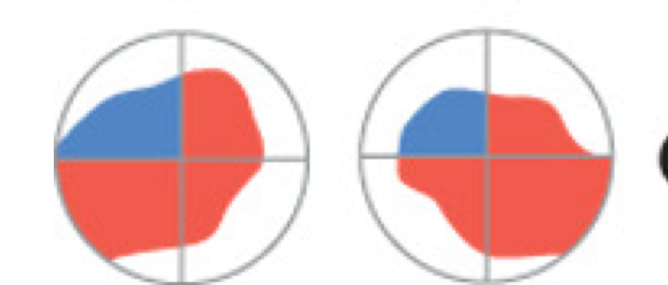 <p>loss of vision in one-quarter of the visual field</p><ul><li><p>due to visual cortex lesions, particularly near calcarine sulcus </p></li></ul><p></p>