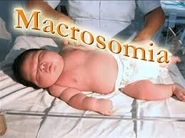 <ul><li><p>enlarged internal organs</p></li><li><p>cord is larger</p></li><li><p>increased fat around shoulders</p></li></ul><p></p>