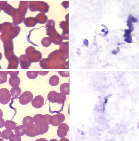 <p>Trypanosoma brucei spp., trypomastigote</p><p>Disease: <u>African sleeping sickness</u></p><p>Vector: <u>Tsetse fly</u></p><p>Transmission: <u>Bite of fly</u></p><p>Infective stage: <u>Metacyclic trypomastigote</u></p><p>Diagnostic stage: <u>Trypomastigote</u></p><p>Treatment: <u>Suramin sodium</u></p>