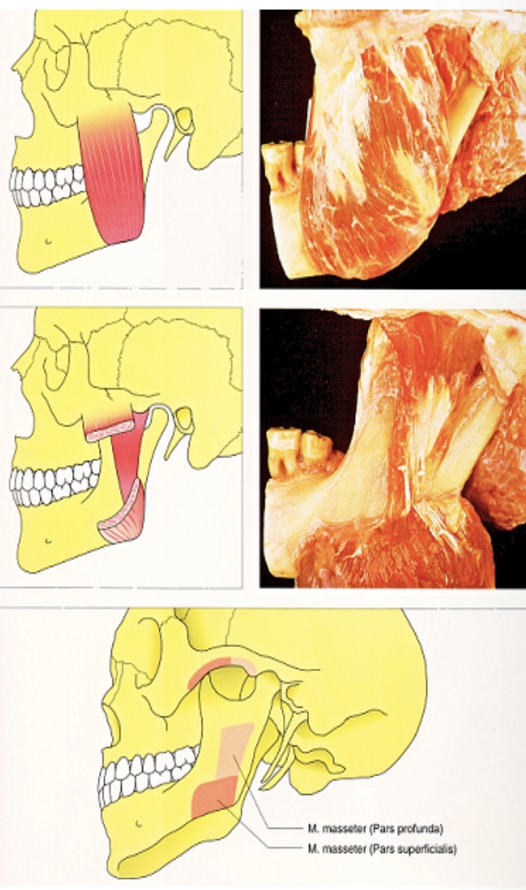 <p>Rectangular muscle that goes from zygomatic arch to inferior edge of mandible</p><p>Insertion in jaw from 2nd molar at lower edge to angle</p><p>Superficial (for protrusion) and deep (retrusion) portions</p>