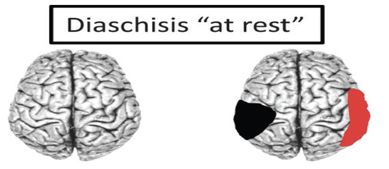 <p>Diaschisis at rest</p>