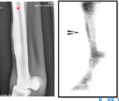 <p>treatment for bucked shins</p>