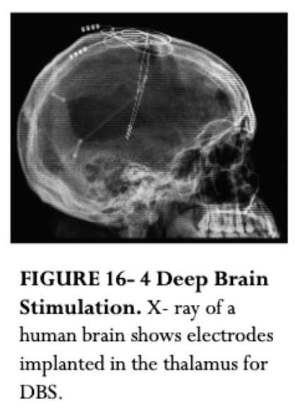 <p><strong>Deep Brain Stimulation (DBS)</strong></p><ul><li><p>Not yet approved by the FDA</p></li><li><p>Neurosurgery in which an electrodes implanted in the brain stimulate a targeted area with a low-voltage electrical current to facilitate behavior</p></li></ul><p><strong>Hallucinogen psilocybin </strong>is in clinical trials for resistant depression. Trial was scheduled to be completed in 2021.</p><p><strong>Light therapy</strong></p><ul><li><p>For Seasonal Affective Disorder</p></li></ul><p><strong>Sleep deprivation</strong></p>