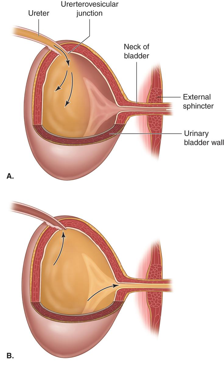 <p>The ureters enter the bladder at an angle, forming a functional one-way valve that prevents backflow into the kidney. This is termed the <strong>ureterovesicular junction</strong>. </p>