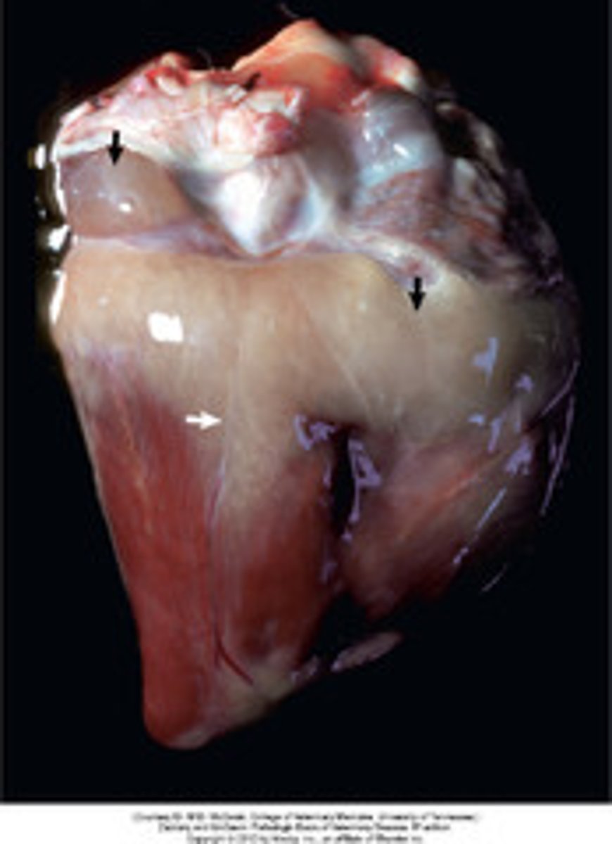 <p>adipose upon surface of myocardium</p>