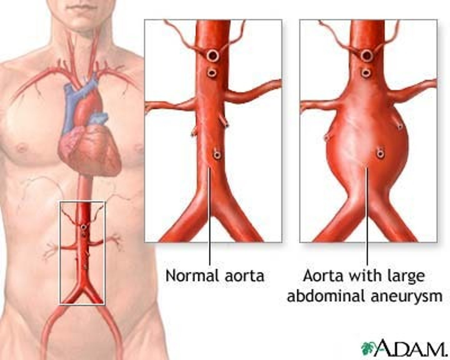 <p>The dilation, or ballooning, of a weakened section of the wall of an artery</p>