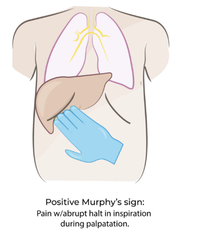 <p>Pain when breathing in during RUQ palpation → gallbladder inflammation (cholecystitis)</p>